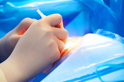 DSEK Surgical Procedure