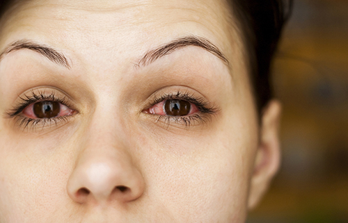 Scleritis Uveitis